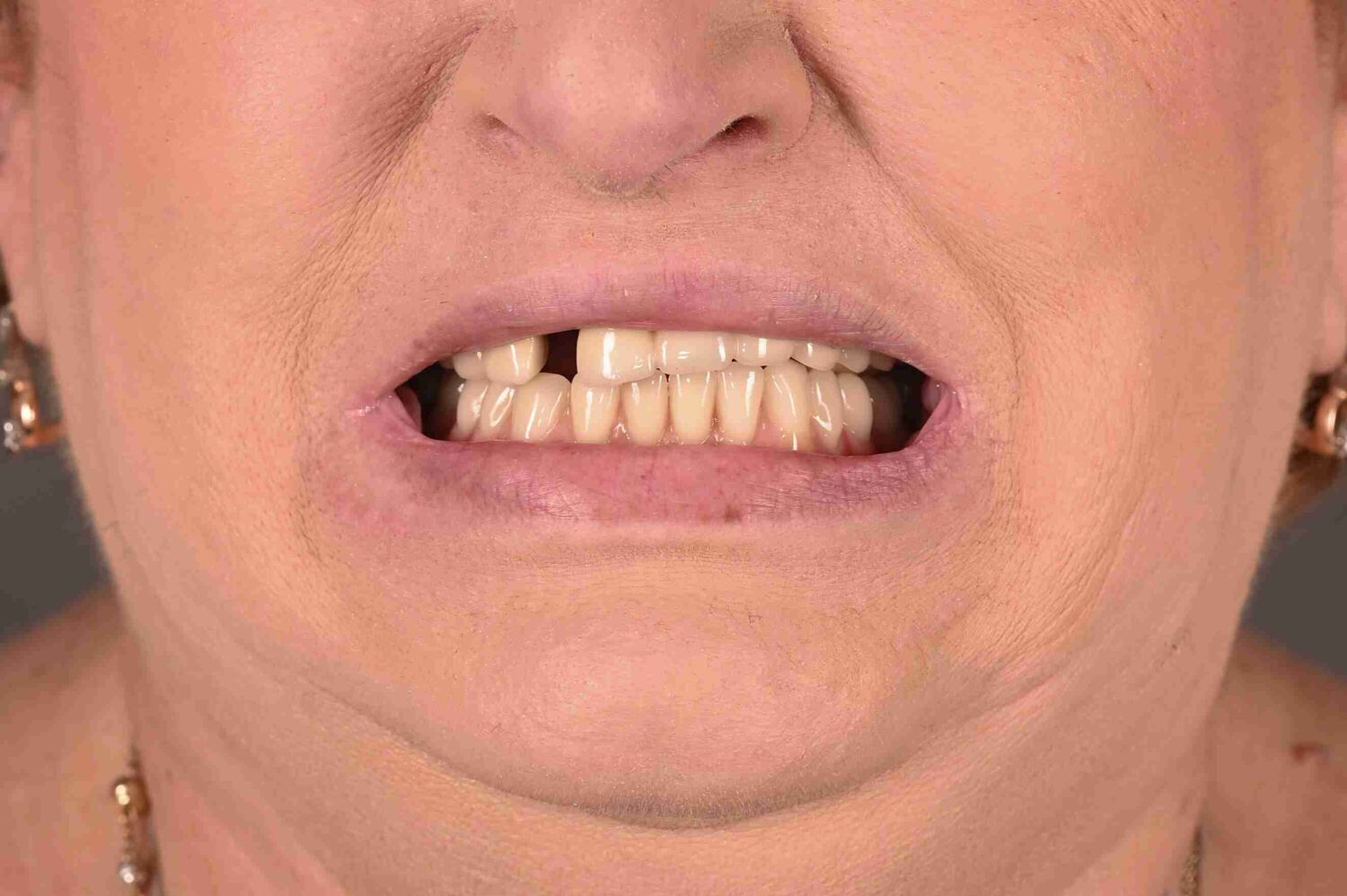 Pacient Clinica Dr. Alin Odor - Rezultat Implantologie
